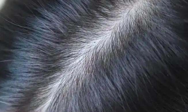 女性头皮长痣代表什么